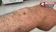 Karaman'da itfaiye erinin koluna yapışan kene hastanede çıkarıldı