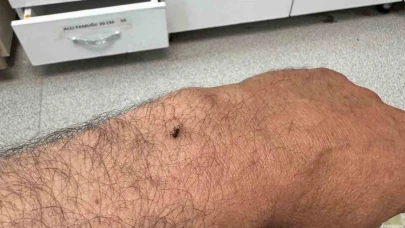Karaman'da itfaiye erinin koluna yapışan kene hastanede çıkarıldı