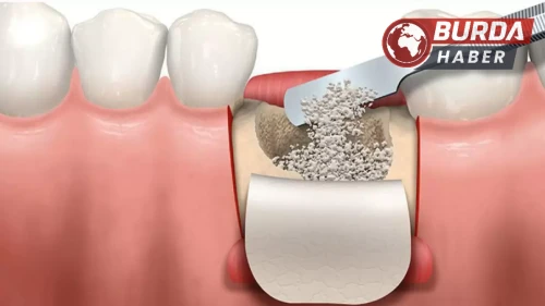Kalçadan alınan kemik çene kemiği yetersizliğine umut oluyor