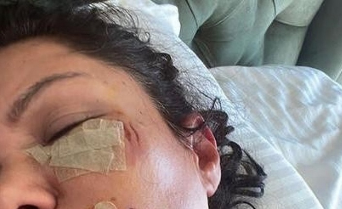 Ünlü şarkıcı Tuğba Altıntop köpek saldırısına uğradı